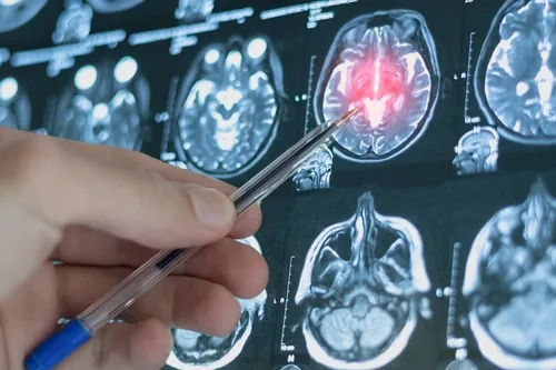 Beyin Anevrizması Nedir? Nedenleri, Belirtileri ve Tedavi Yaklaşımları