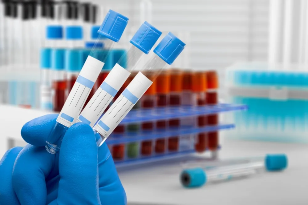 Hemogram (Tam Kan Sayımı) Nedir? Hemogram (Tam Kan Sayımı) Testi Hangi Hastalıkların Tanısı İçin Yapılır?