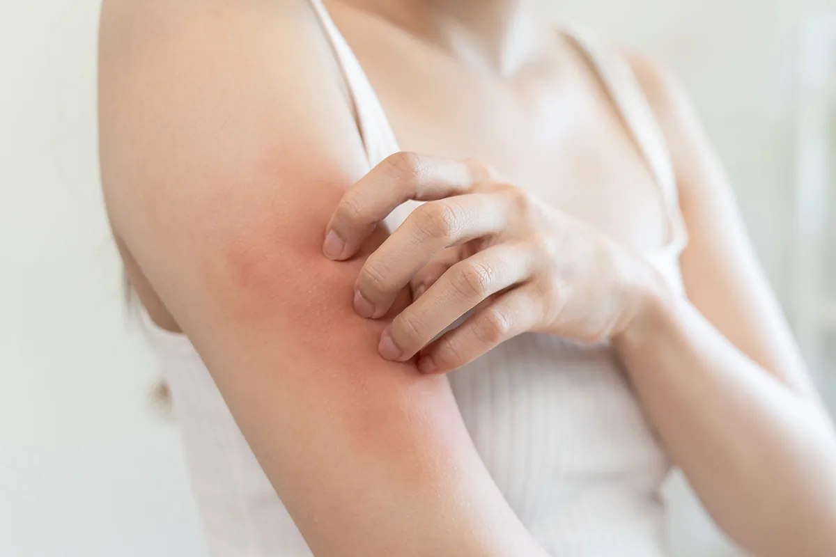 Egzama Nedir? Belirtileri, Nedenleri ve Tedavi Yöntemleri