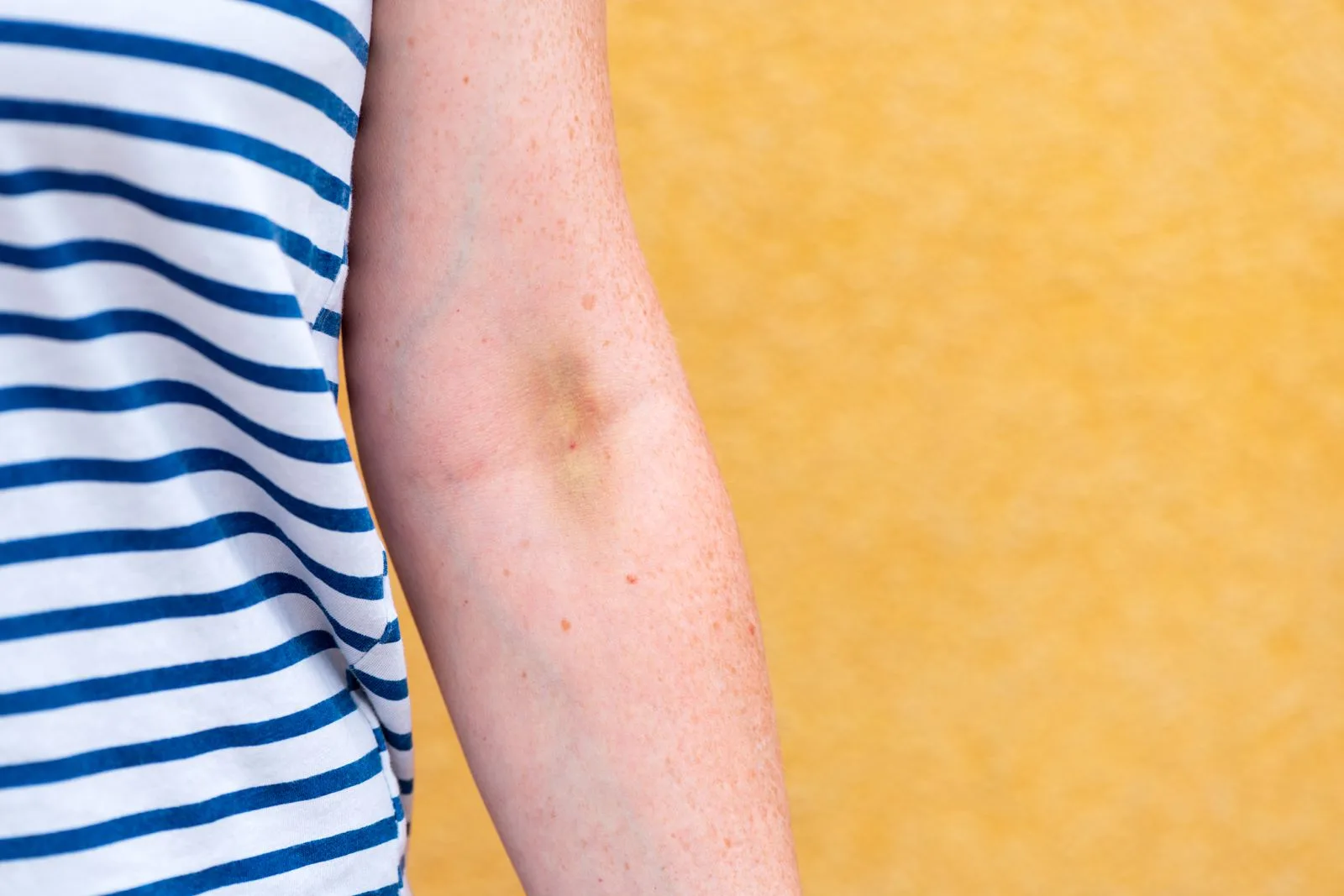 Ekimoz Nedir? Belirtileri ve Tedavi Yöntemleri