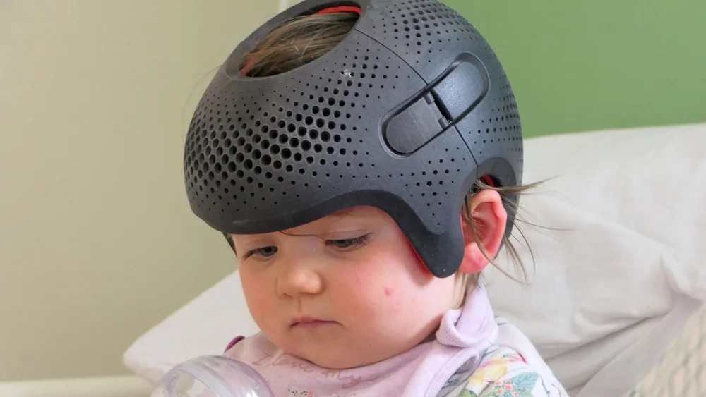 Bebeklerde Pozisyonel Plagiosefali (Düz Kafa-Yamuk Kafa- Yassı Kafa) Nedir?