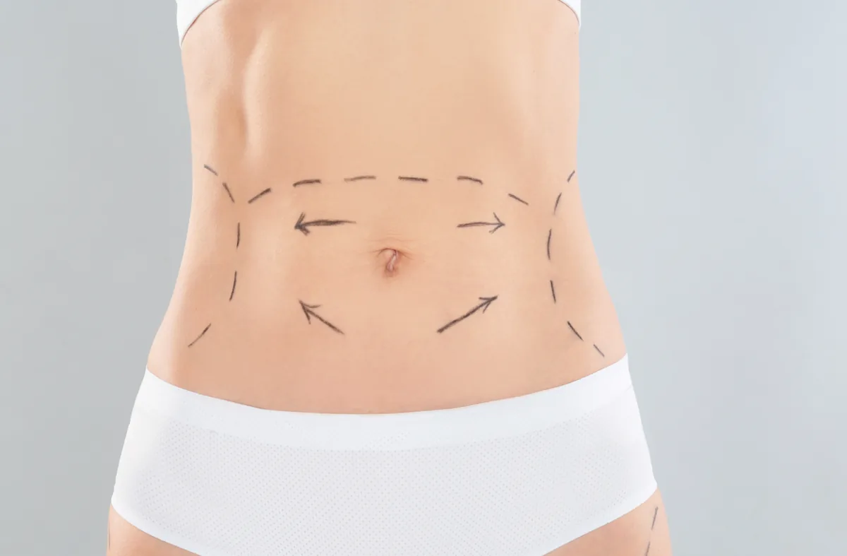Abdominoplasty (Tummy Tuck Surgery)