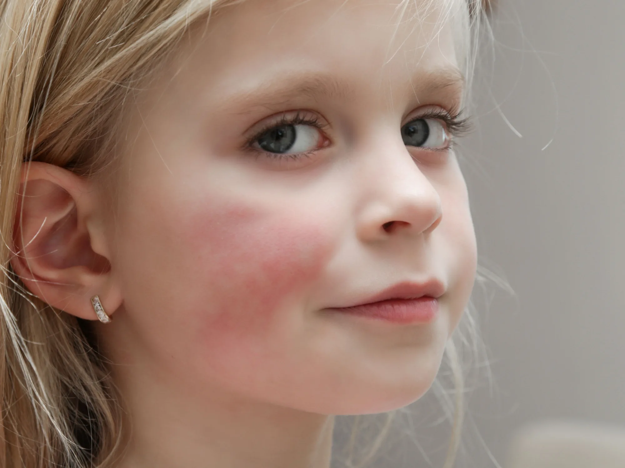 'Beşinci Hastalık' Nedir? Belirtileri ve Tedavi Yöntemleri Nelerdir?