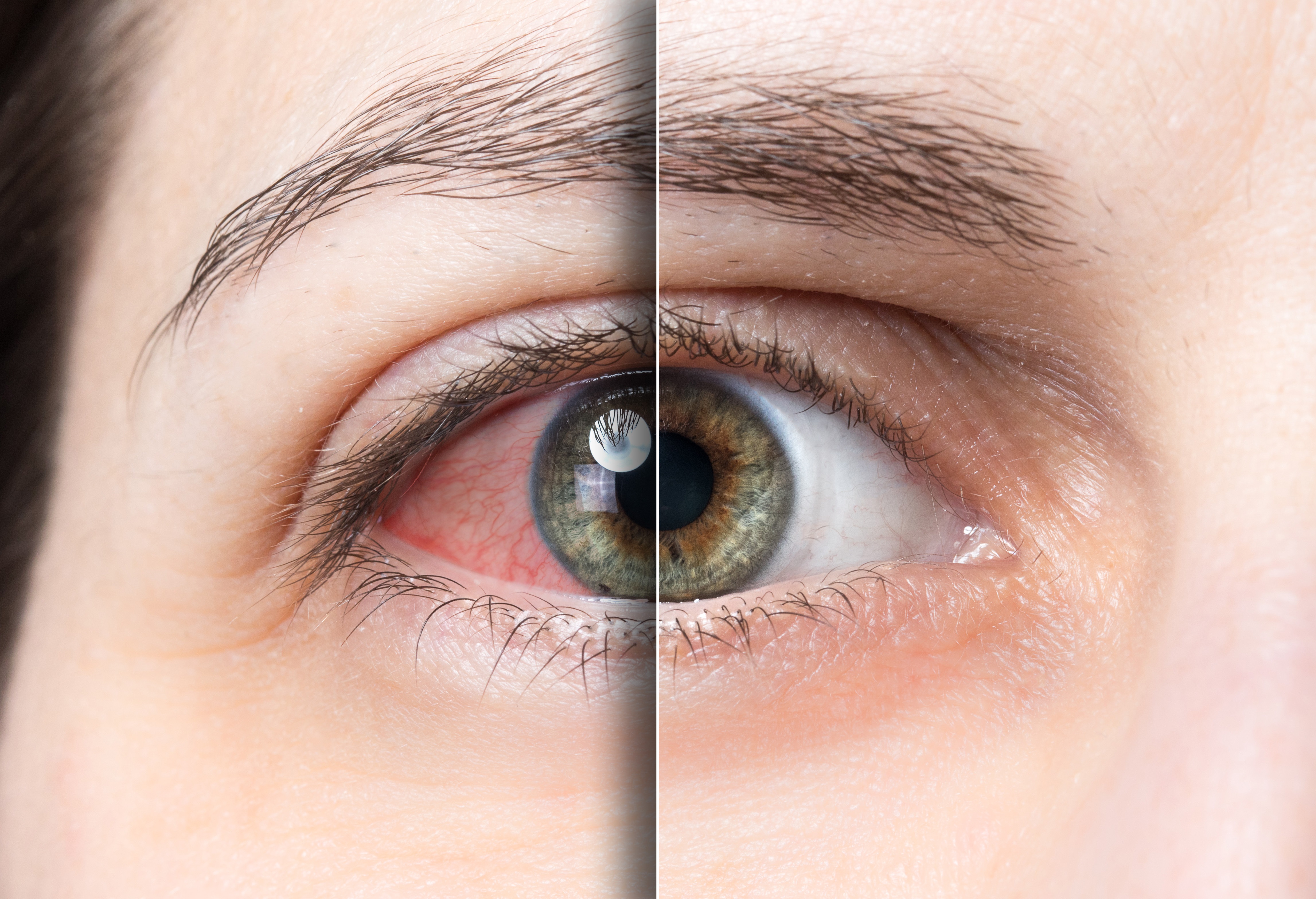 Adenoviral Konjonktivit Nedir? Belirtileri Nelerdir?