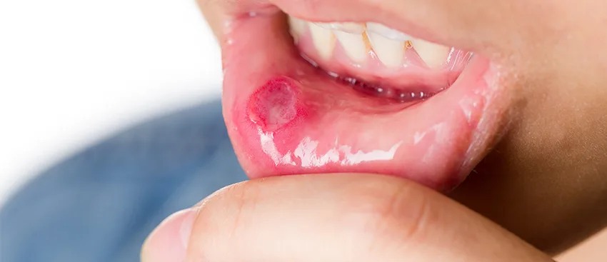 Behçet Hastalığı Nedir? Behçet Hastalığının Belirtileri Nelerdir?