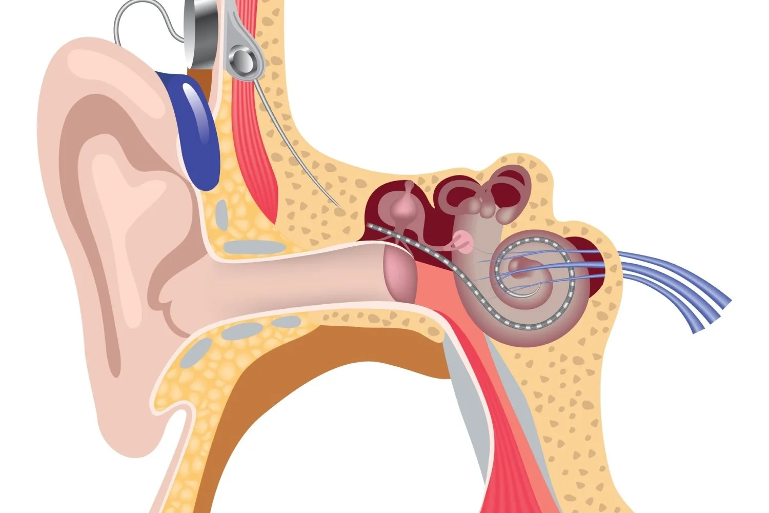 Koklear İmplant (Biyonik Kulak) Nedir? Koklear İmplantın Faydaları Nelerdir?
