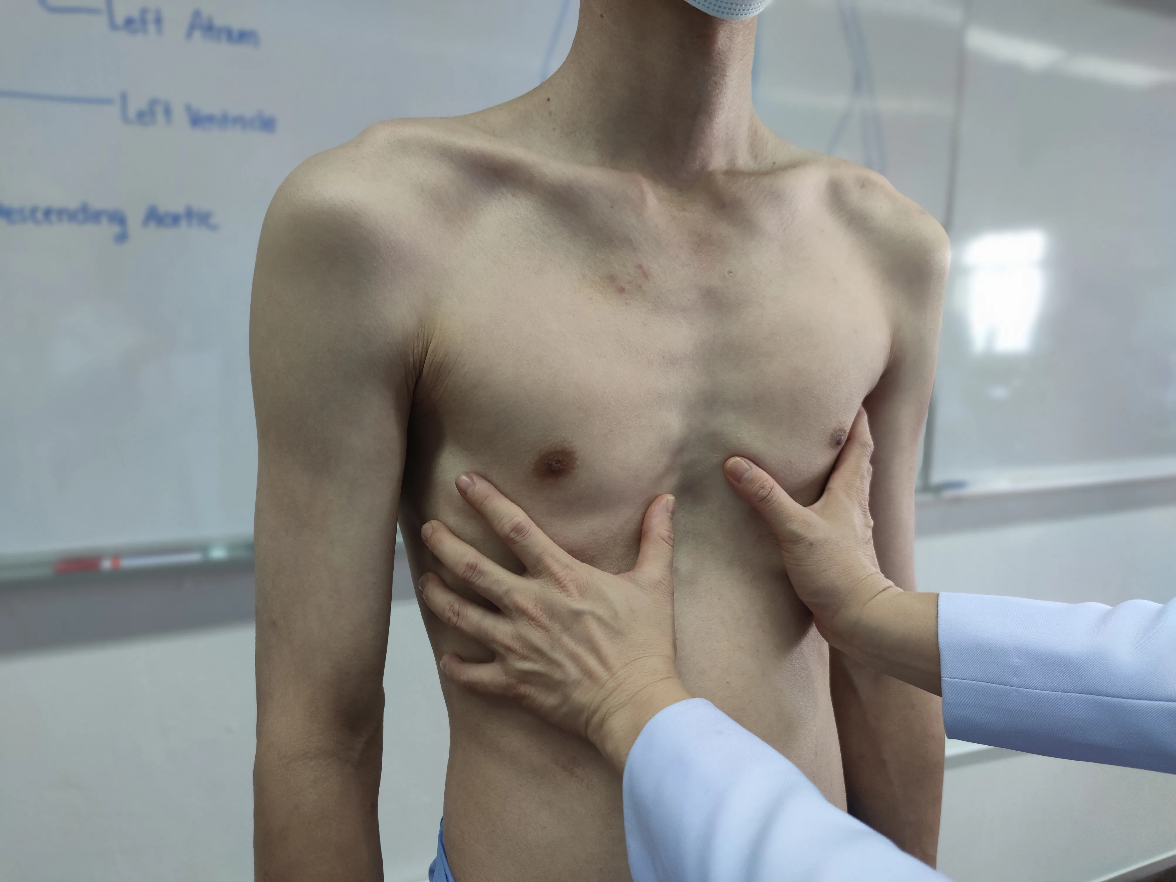 Göğüs Kafesi Şekil Bozuklukları (Kunduracı Göğüs ve Güvercin Göğüs)