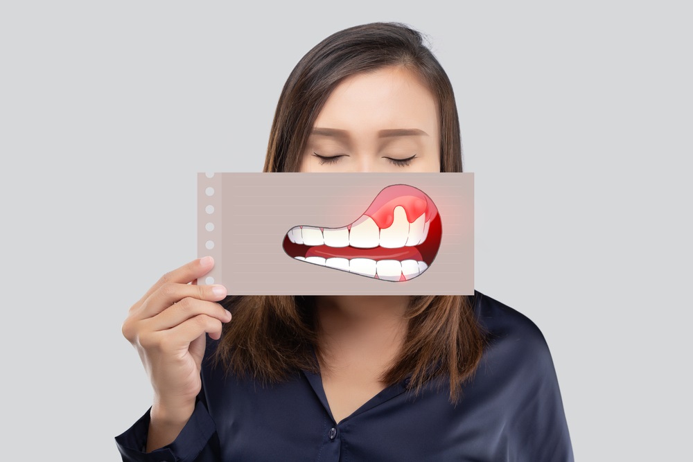 Diş Eti Çekilmesi Nedir? Diş Eti Çekilmesinin Belirtileri Nelerdir?