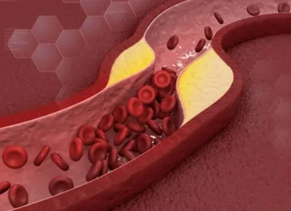 Dislipidemi Nedir ve Belirtileri Nelerdir?