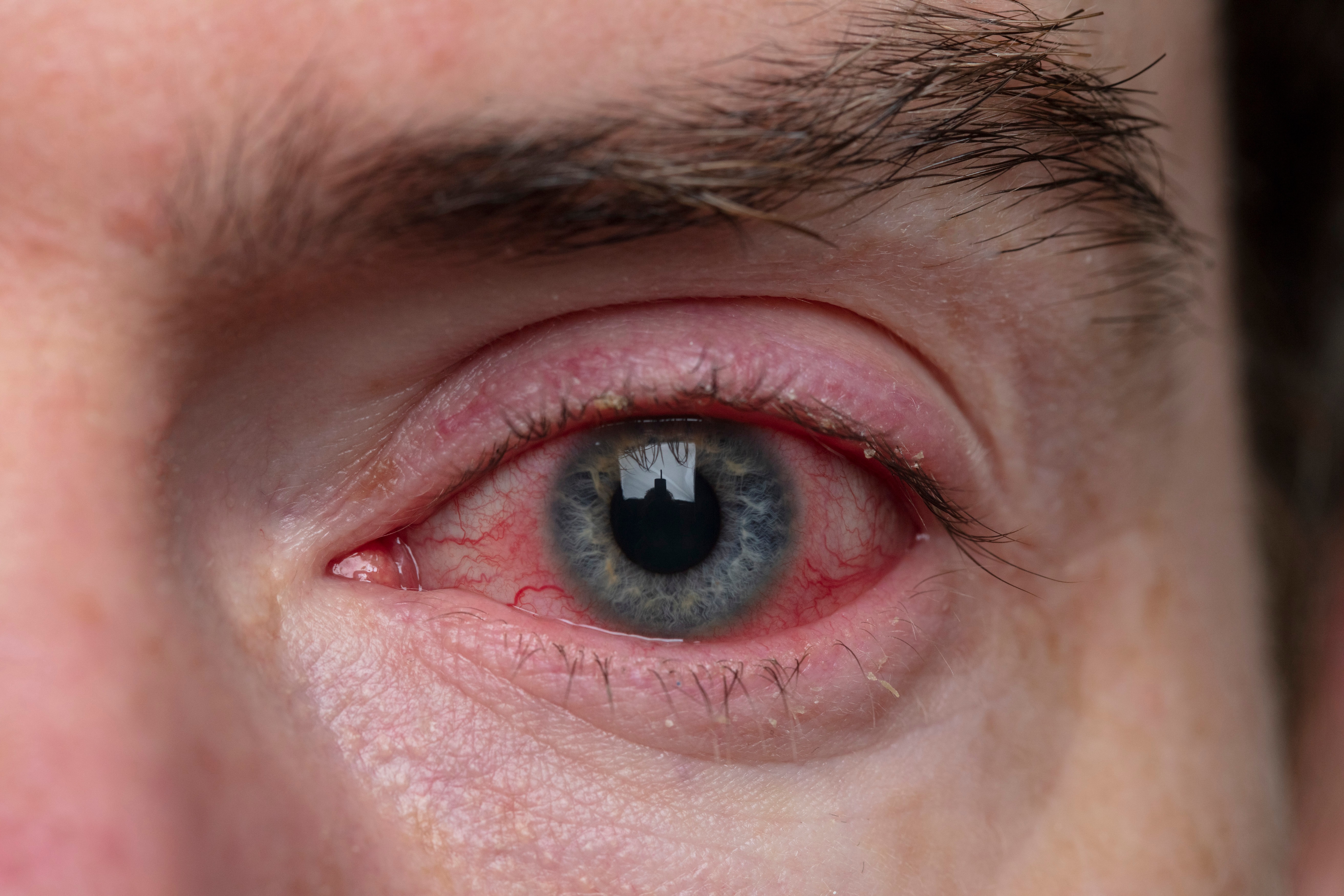 Diyabetik Retinopati Nedir? Belirtileri Nelerdir?