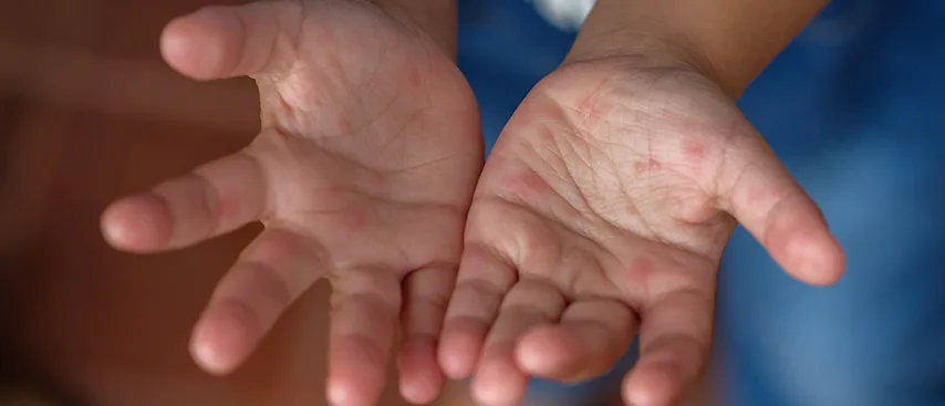 El Ayak Ağız Hastalığı Belirtileri, Tanı, Tedavi Ve Korunma Yöntemleri