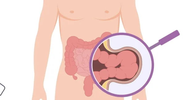 Fıtık Nedir? Belirtileri ve Tedavi Yöntemleri Nelerdir?