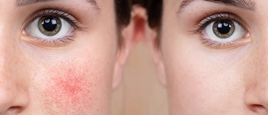 Gül Hastalığının Nedir? Gül Hastalığı Belirtileri, Tanı ve Tedavi Yöntemleri Nelerdir?