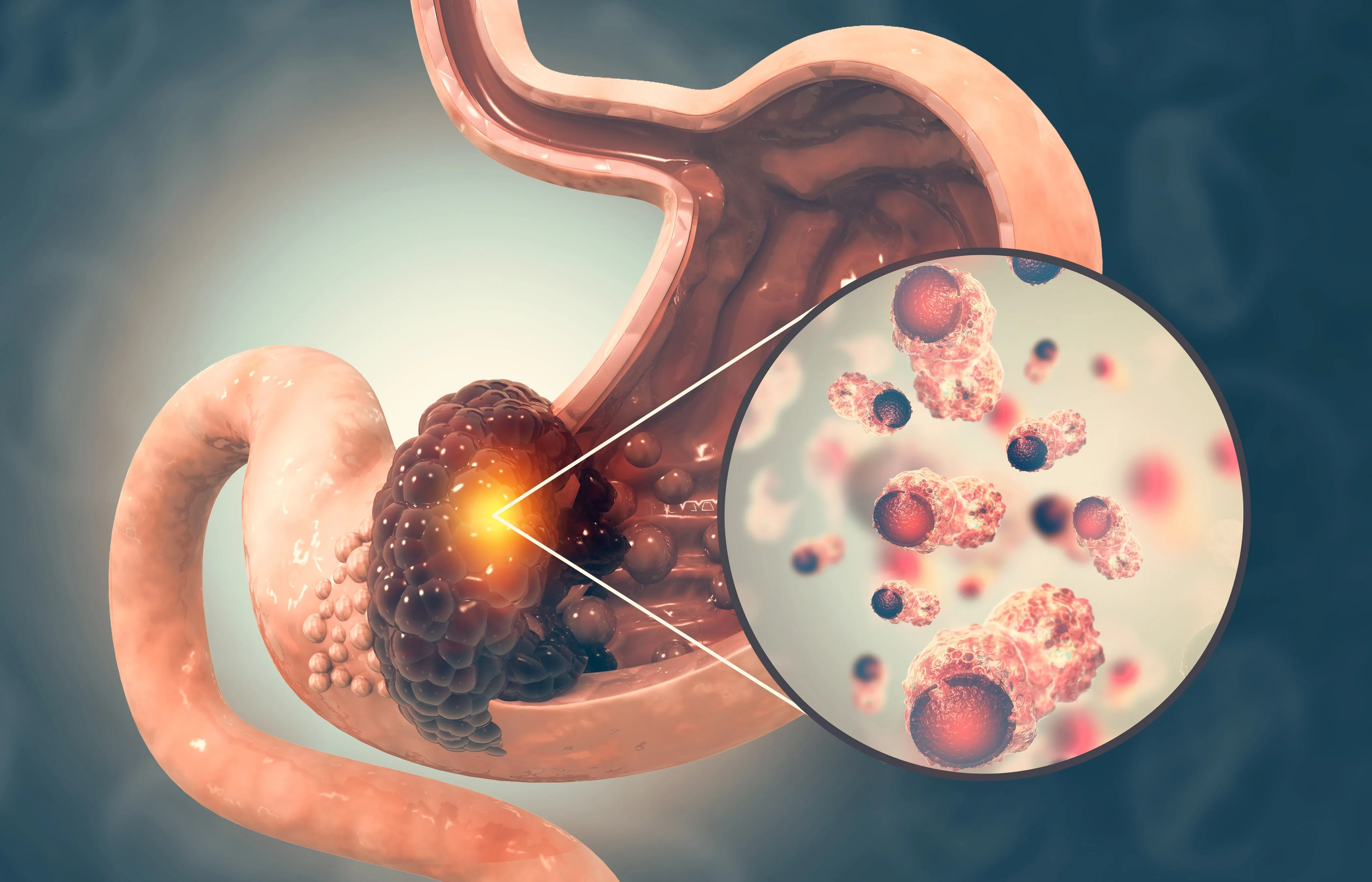 Mide Kanseri Nedir? Mide Kanseri Belirtileri, Nedenleri ve Tedavisi