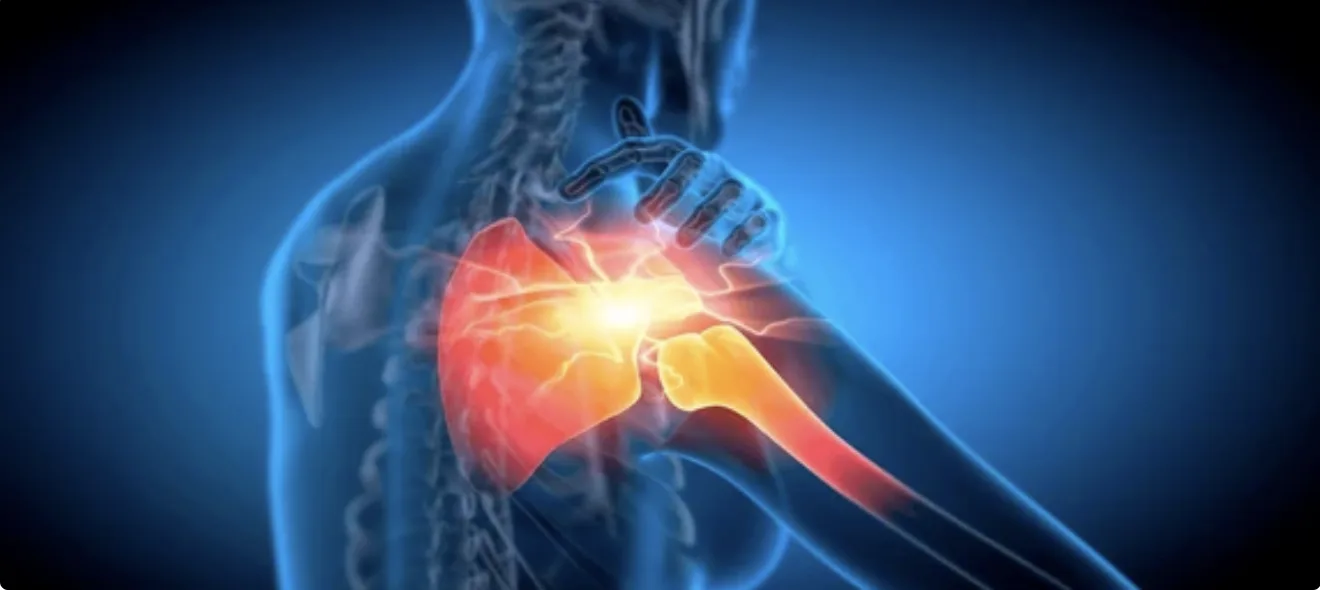 Omuz Sıkışması Nedir? Omuz Sıkışması Nasıl Tedavi Edilir?