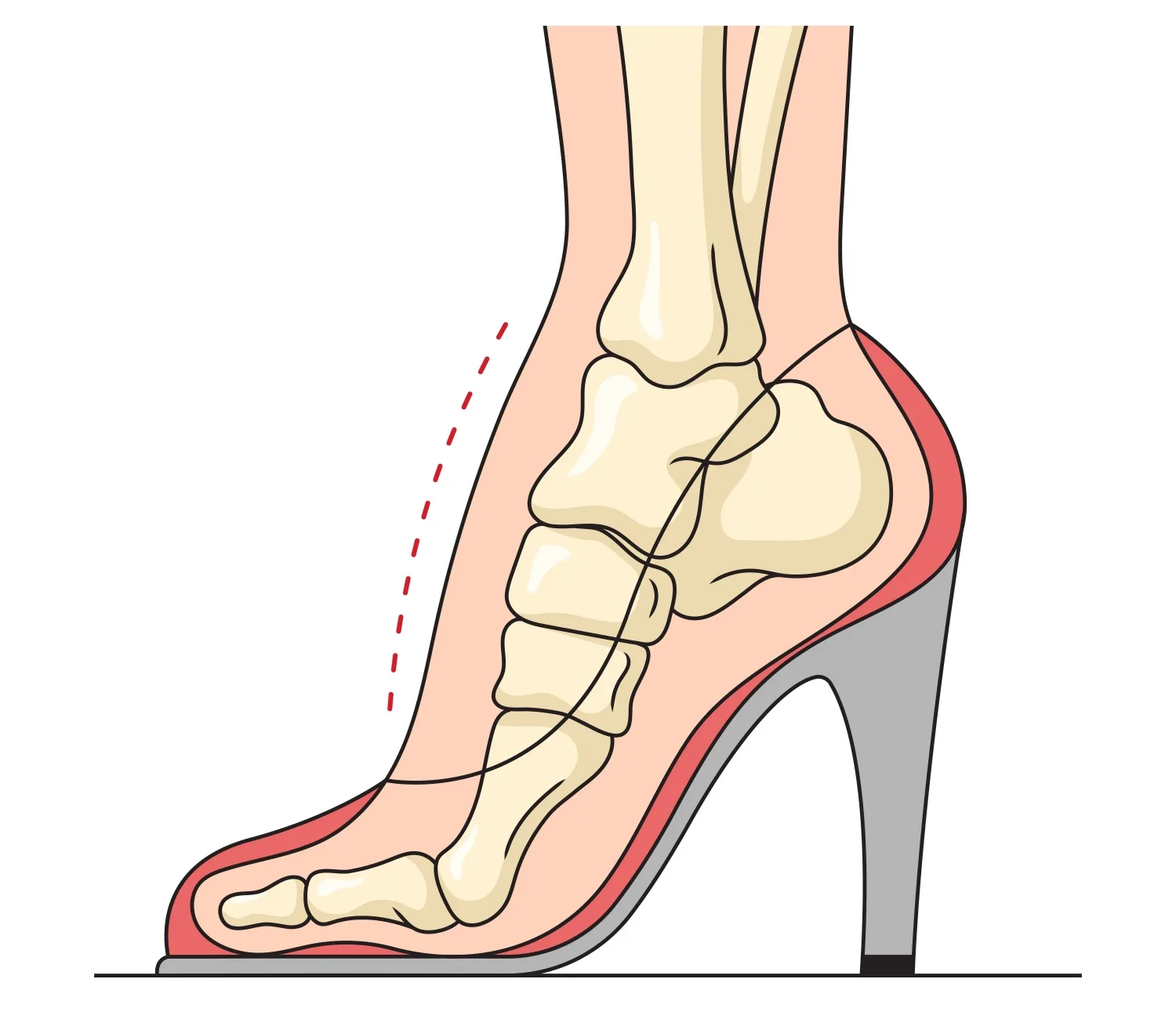Topuklu Ayakkabı Giyenler Dikkat!